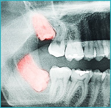 xray