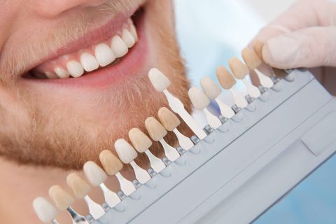 Dental Veneers